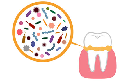 歯周病の原因は”細菌”です